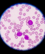 Leucemia linfoblastica acuta: nuovo metodo per scoprire la probabilità di recidiva alla diagnosi